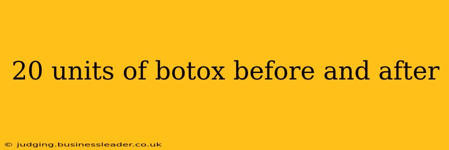 20 units of botox before and after