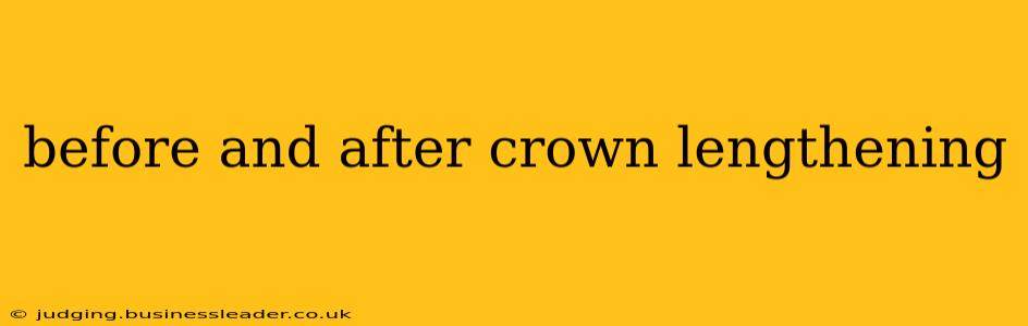 before and after crown lengthening