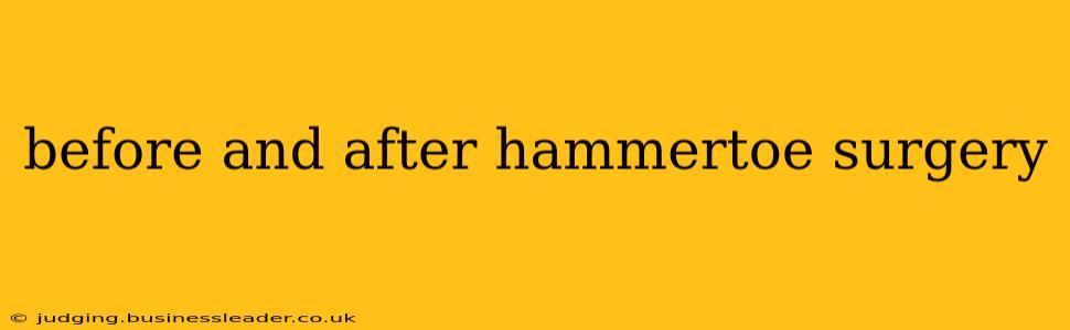 before and after hammertoe surgery
