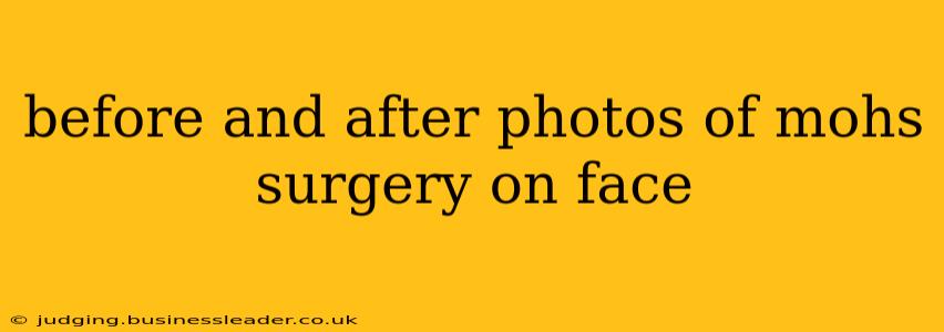 before and after photos of mohs surgery on face