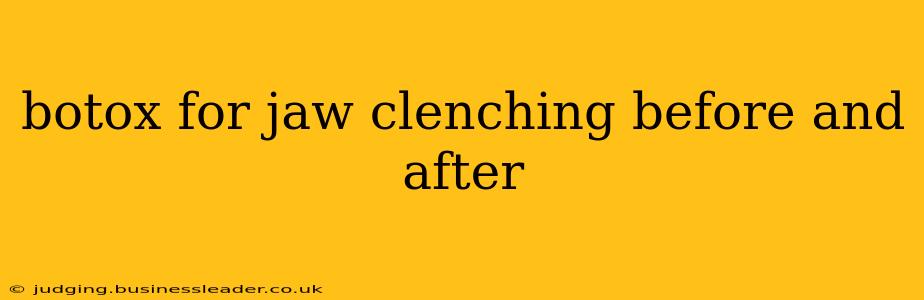 botox for jaw clenching before and after
