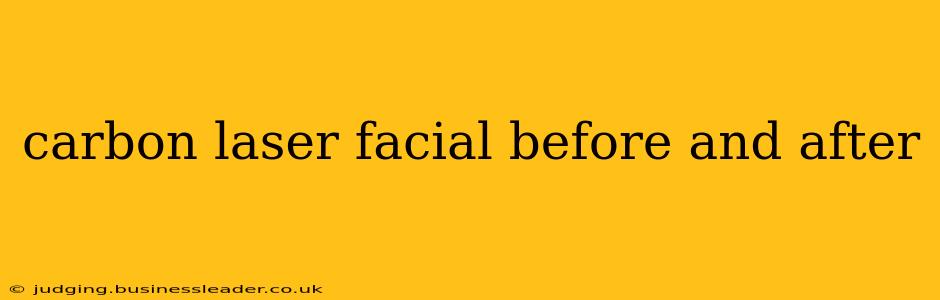 carbon laser facial before and after