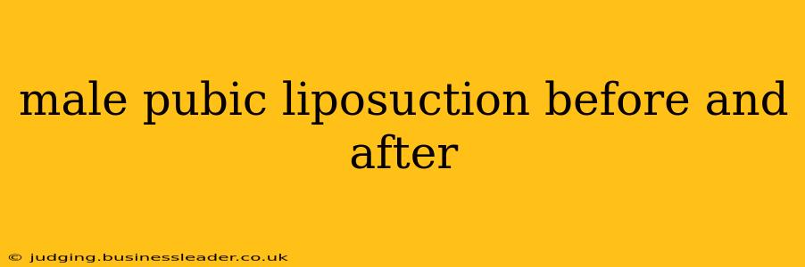male pubic liposuction before and after