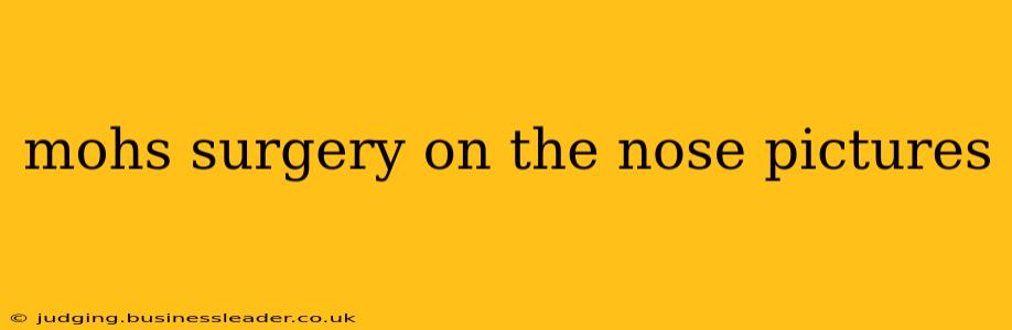 mohs surgery on the nose pictures