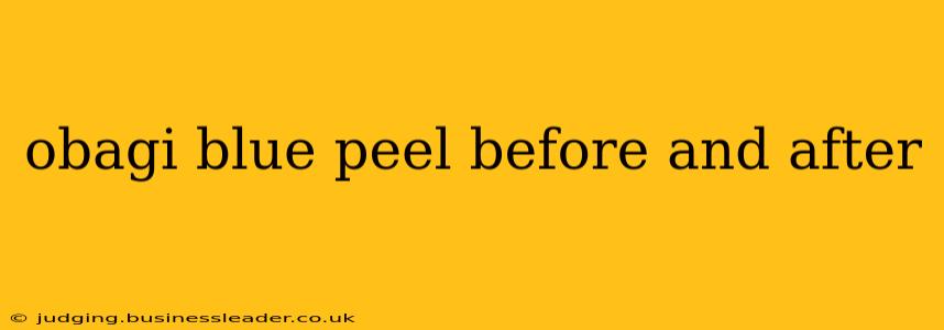 obagi blue peel before and after