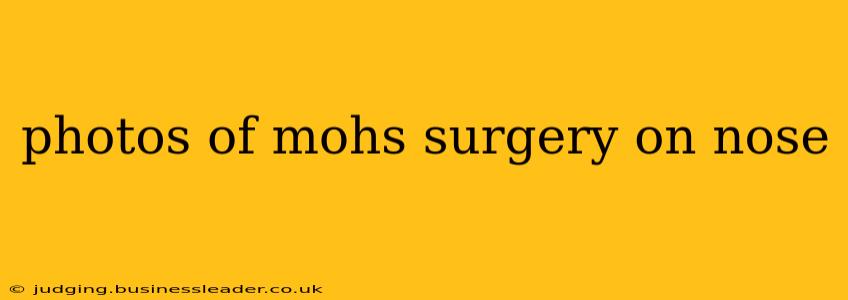 photos of mohs surgery on nose