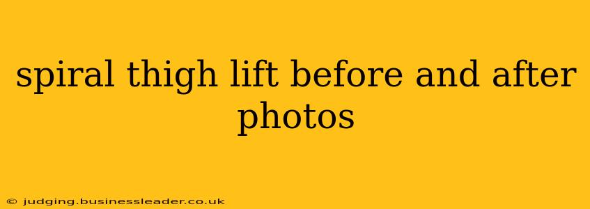 spiral thigh lift before and after photos