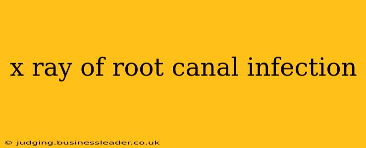 x ray of root canal infection